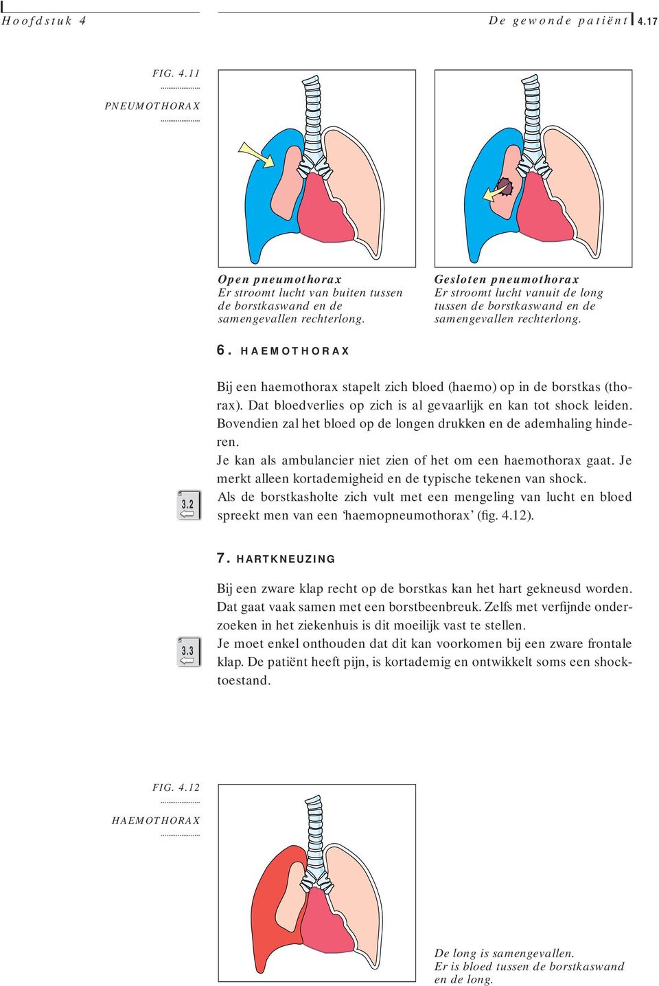 2 Bij een haemothorax stapelt zich bloed (haemo) op in de borstkas (thorax). Dat bloedverlies op zich is al gevaarlijk en kan tot shock leiden.