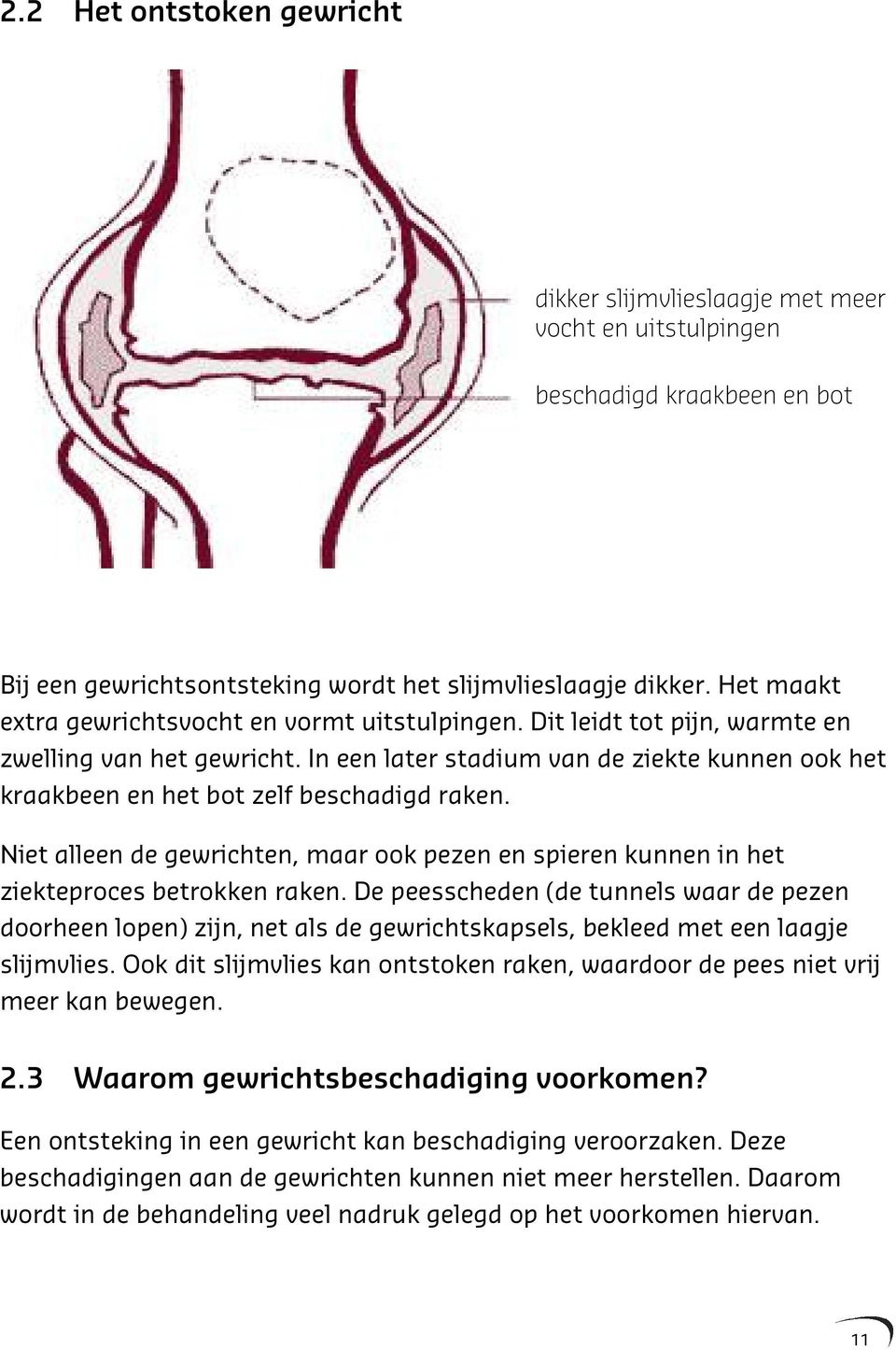 In een later stadium van de ziekte kunnen ook het kraakbeen en het bot zelf beschadigd raken. Niet alleen de gewrichten, maar ook pezen en spieren kunnen in het ziekteproces betrokken raken.