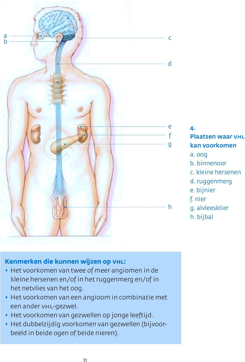 bijbal Kenmerken die kunnen wijzen op vhl: Het voorkomen van twee of meer angiomen in de kleine hersenen en/of in het