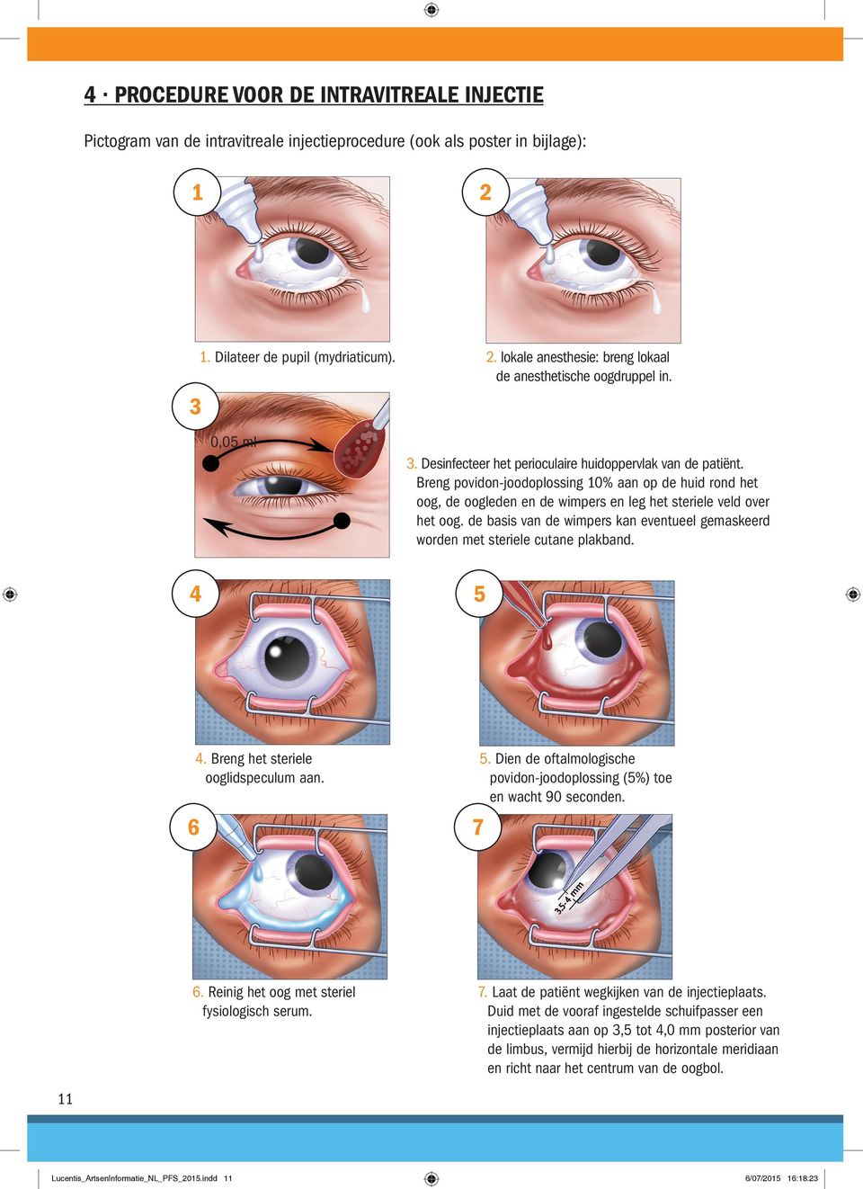 Breng povidon-joodoplossing 10% aan op de huid rond het oog, de oogleden en de wimpers en leg het steriele veld over het oog.