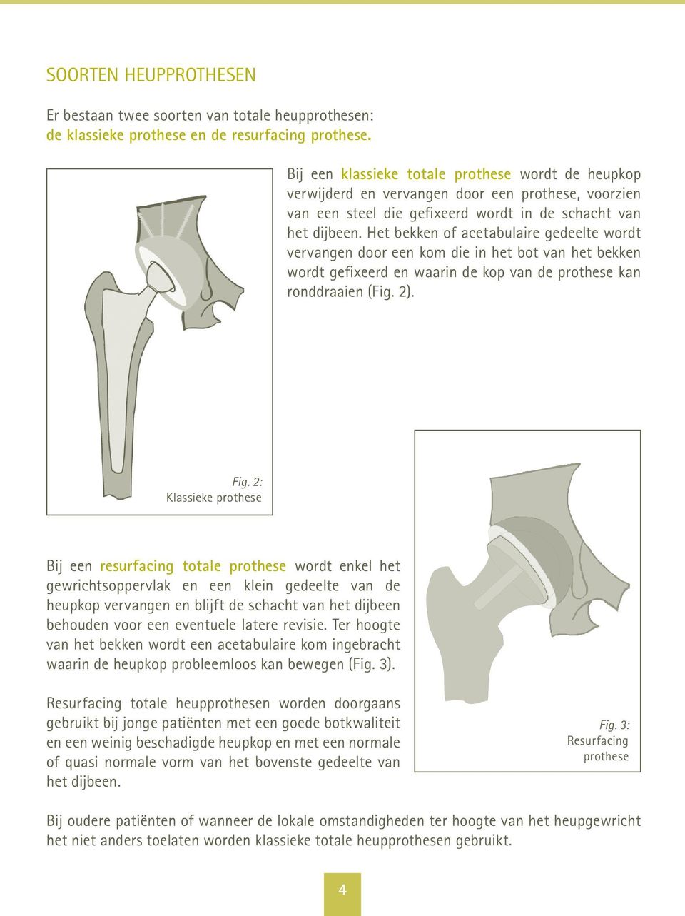 Het bekken of acetabulaire gedeelte wordt vervangen door een kom die in het bot van het bekken wordt gefixeerd en waarin de kop van de prothese kan ronddraaien (Fig. 2). Fig.