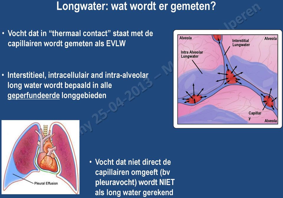 Lungwater Alveola Intra Alveolar Lungwater Interstitieel, intracellulair and intra-alveolar long