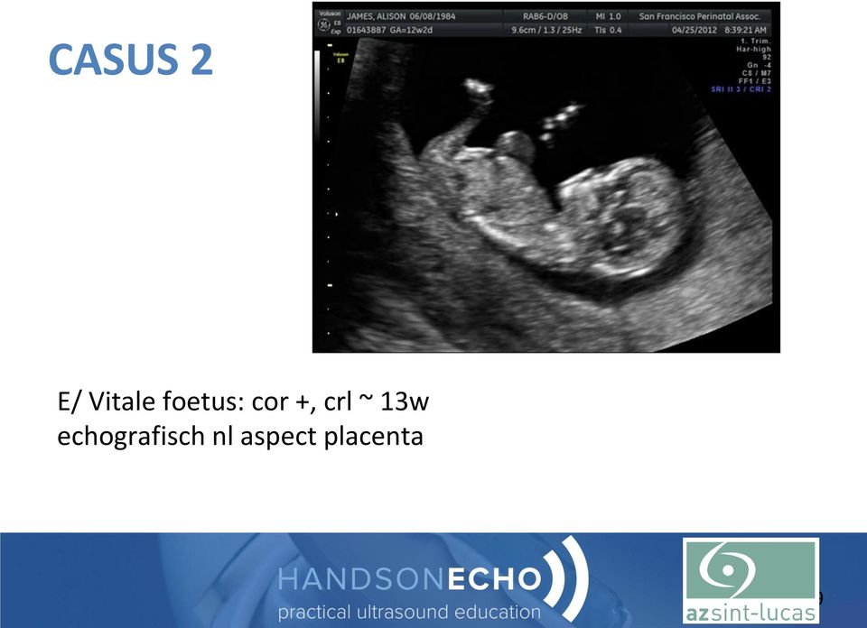 ~ 13w echografisch