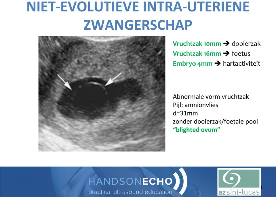Embryo 4mm hartactiviteit Abnormale vorm vruchtzak
