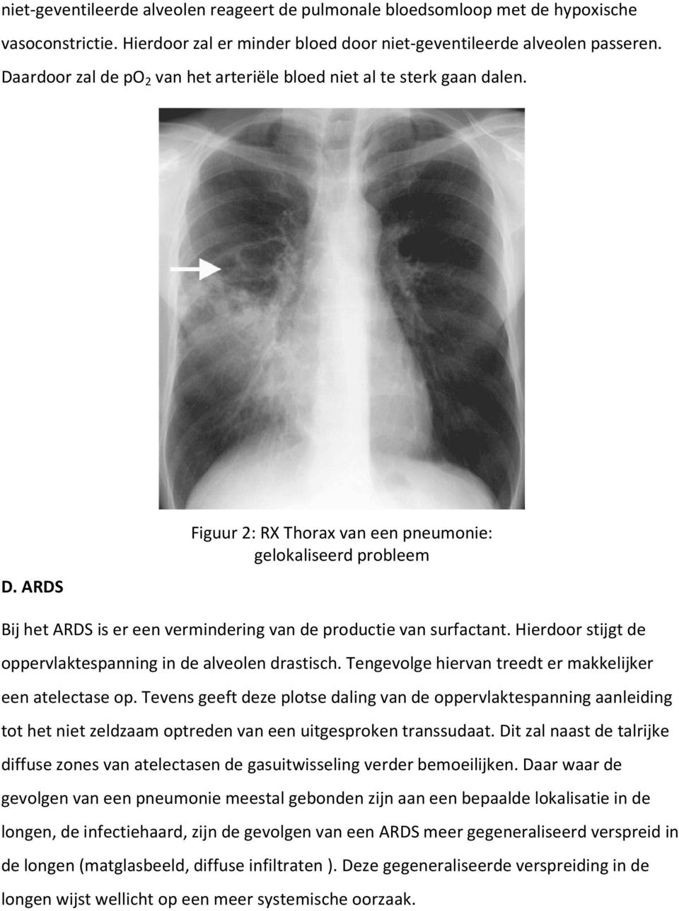 ARDS Figuur 2: RX Thorax van een pneumonie: gelokaliseerd probleem Bij het ARDS is er een vermindering van de productie van surfactant. Hierdoor stijgt de oppervlaktespanning in de alveolen drastisch.