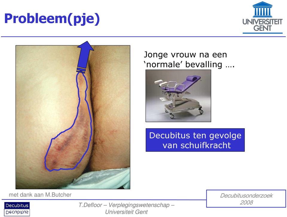 Decubitus ten gevolge van