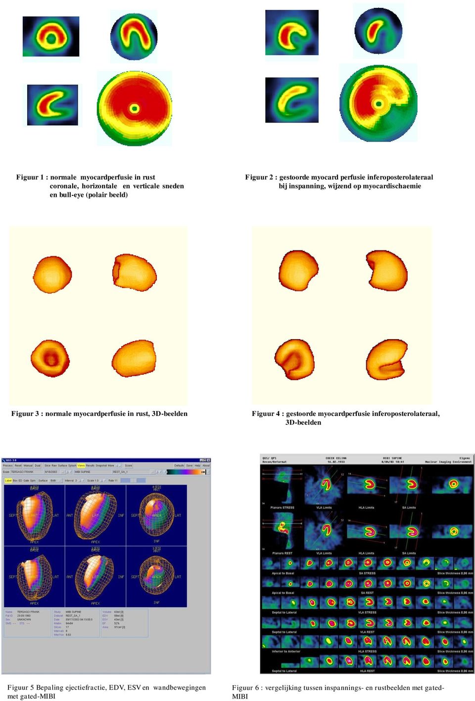 myocardperfusie in rust, 3D-beelden Figuur 4 : gestoorde myocardperfusie inferoposterolateraal, 3D-beelden Figuur 5
