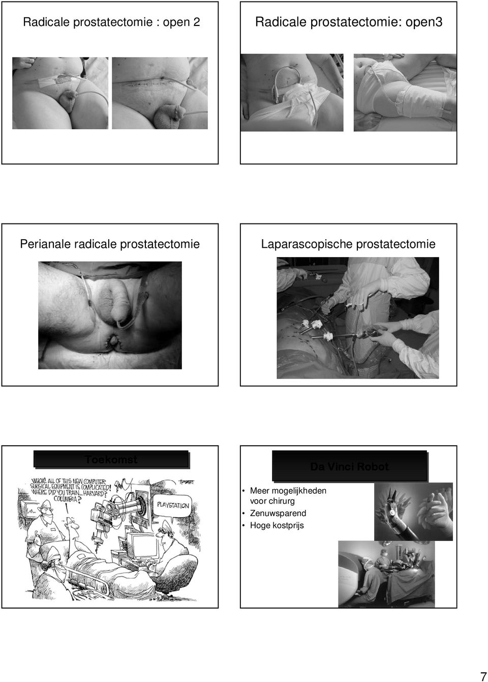 prostatectomie Laparascopische prostatectomie