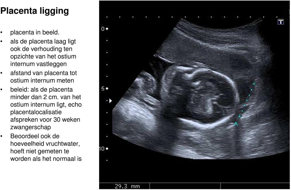 van placenta tot ostium internum meten beleid: als de placenta minder dan 2 cm.
