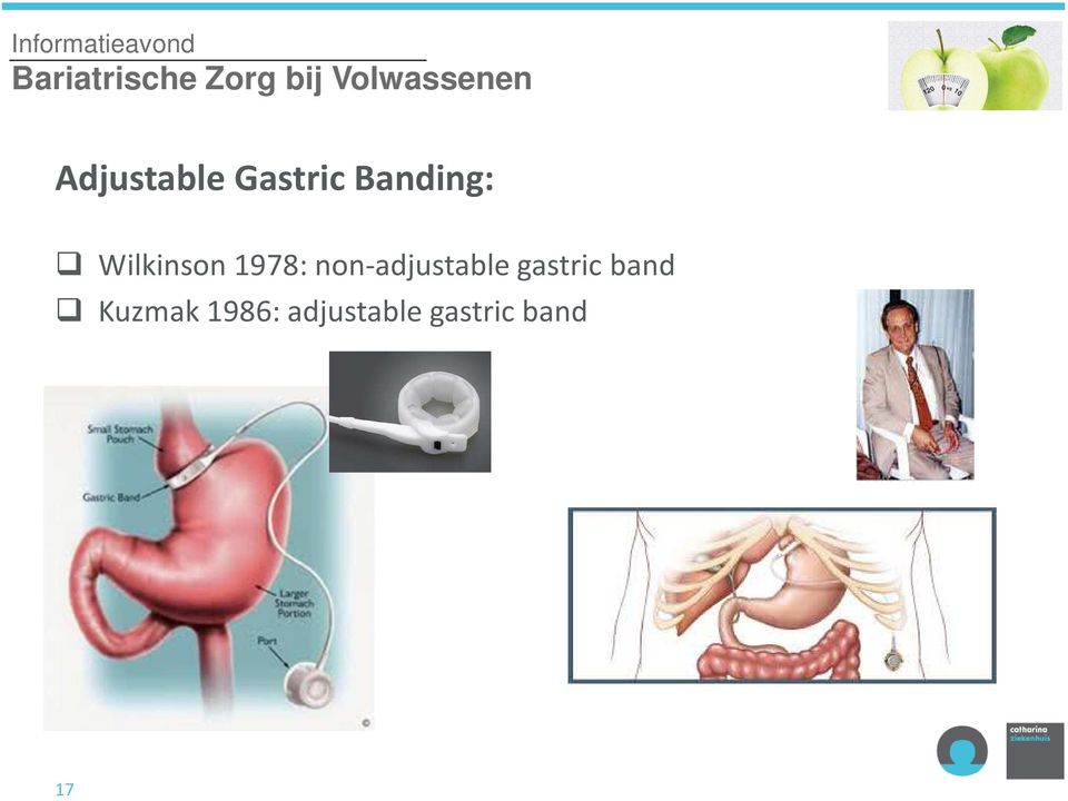 non-adjustable gastric band