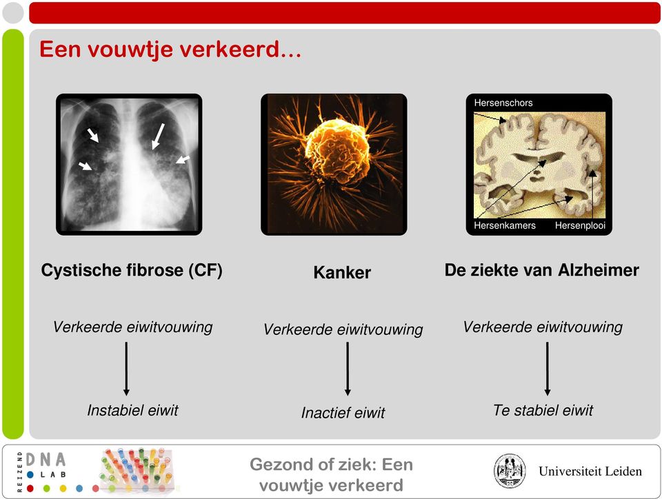 Verkeerde eiwitvouwing Verkeerde eiwitvouwing