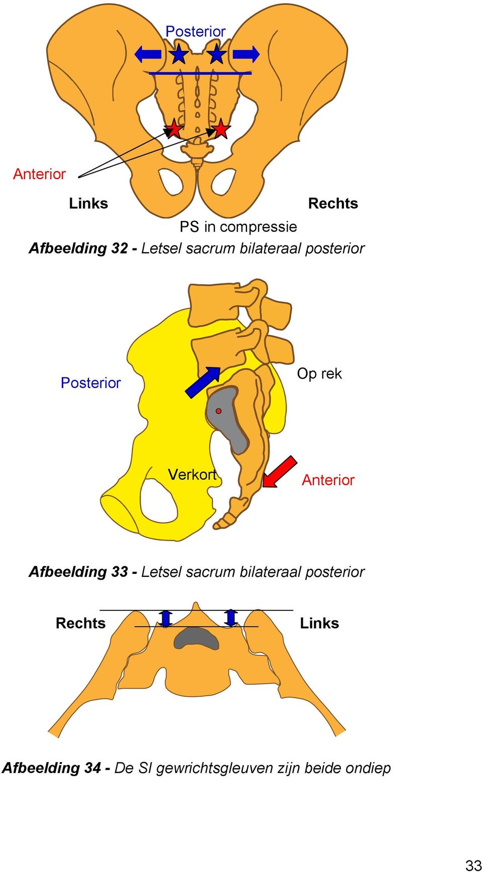 Anterior Afbeelding 33 - Letsel sacrum bilateraal posterior