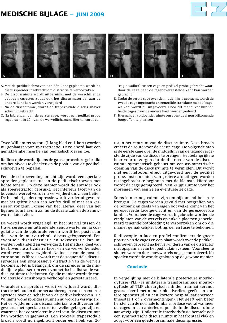 Na de discectomie, wordt de trapezoidale discus shaver schuin ingebracht D. Na inbrengen van de eerste cage, wordt een pedikel probe ingebracht in één van de wervellichamen.