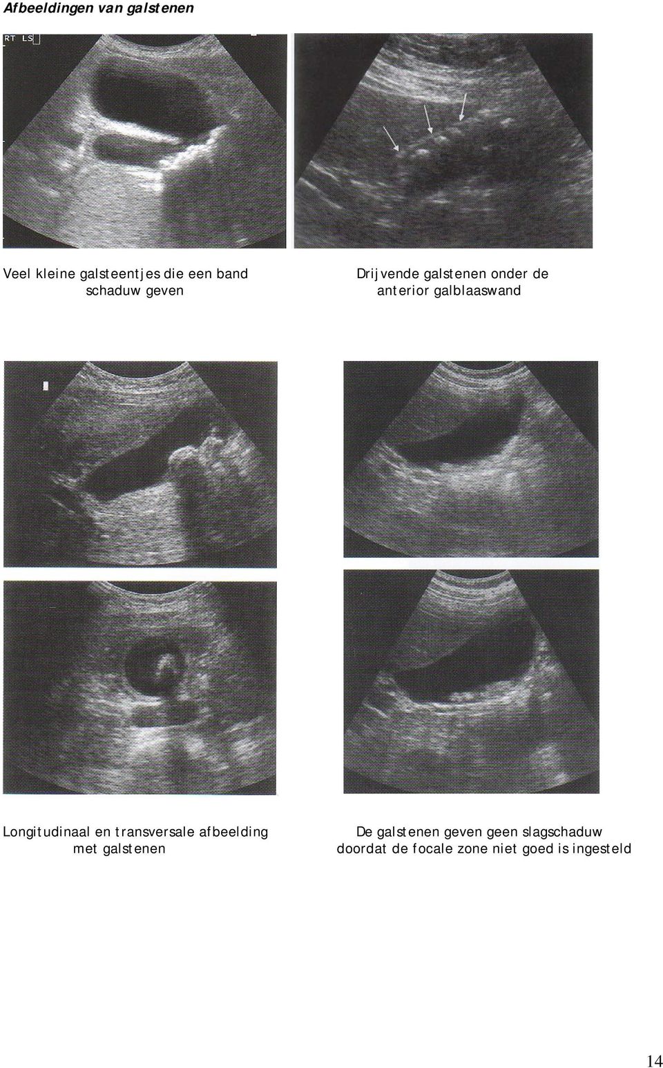 Longitudinaal en transversale afbeelding met galstenen De galstenen