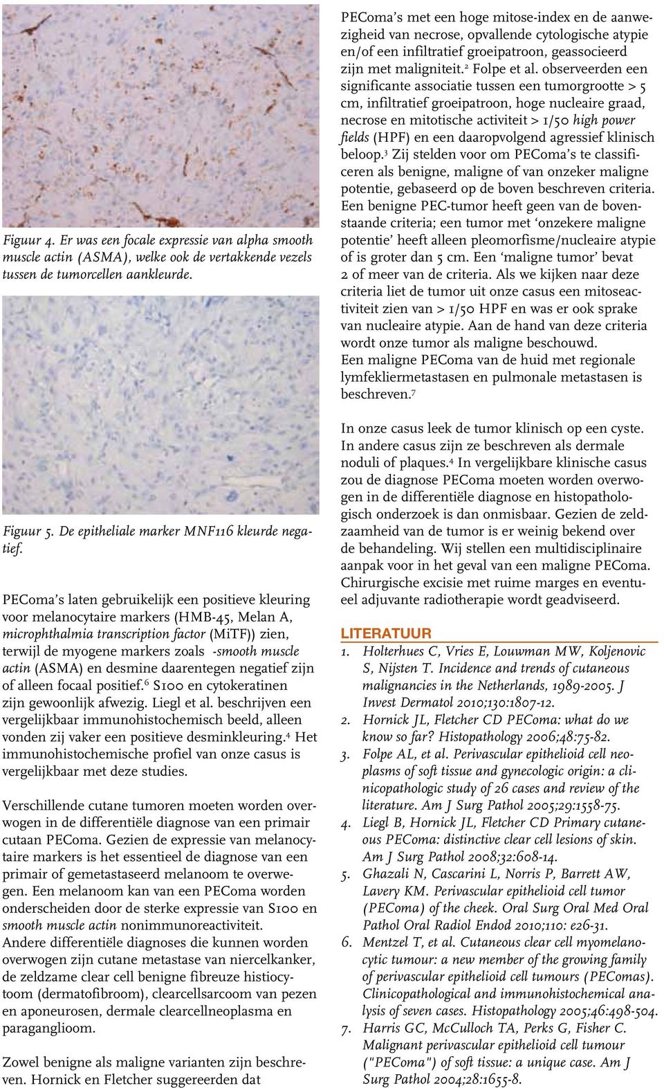 actin (ASMA) en desmine daarentegen negatief zijn of alleen focaal positief. 6 S100 en cytokeratinen zijn gewoonlijk afwezig. Liegl et al.