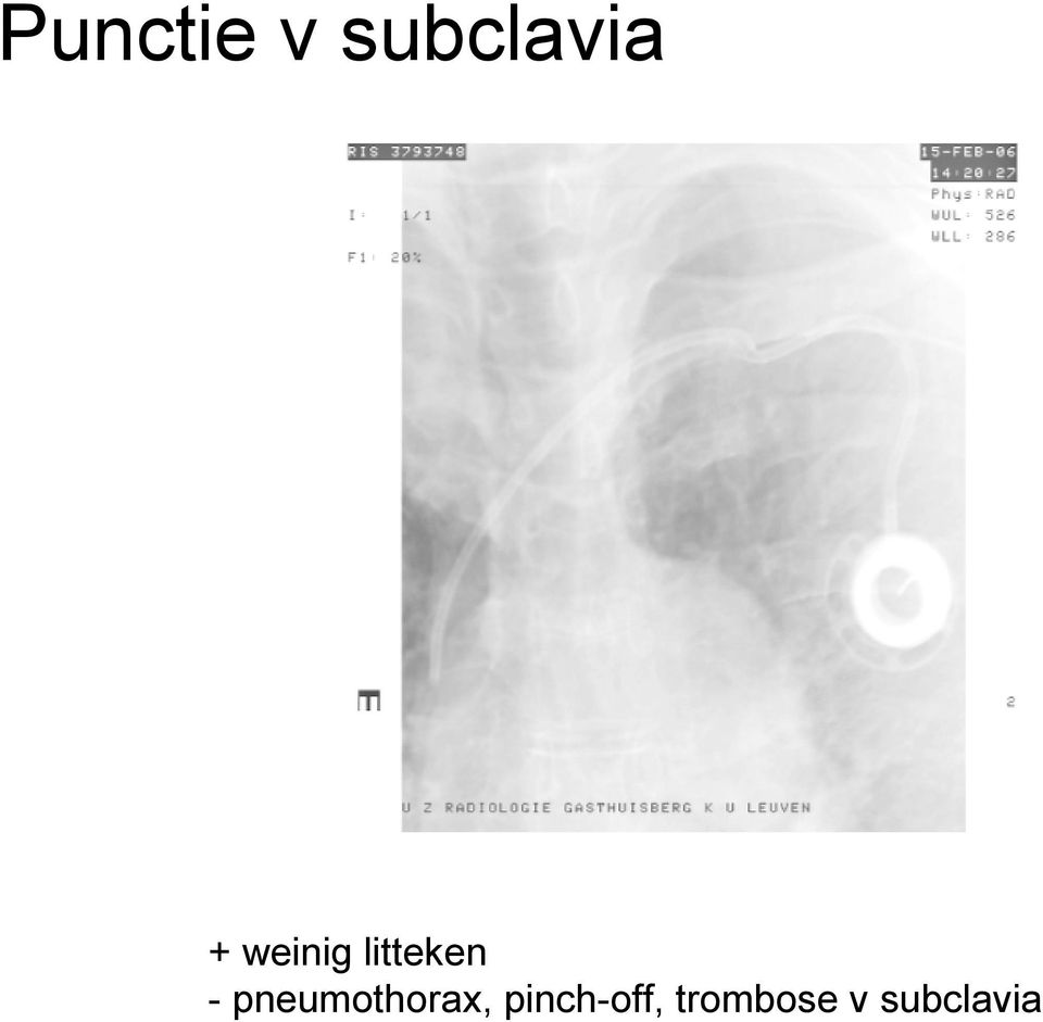 pneumothorax,