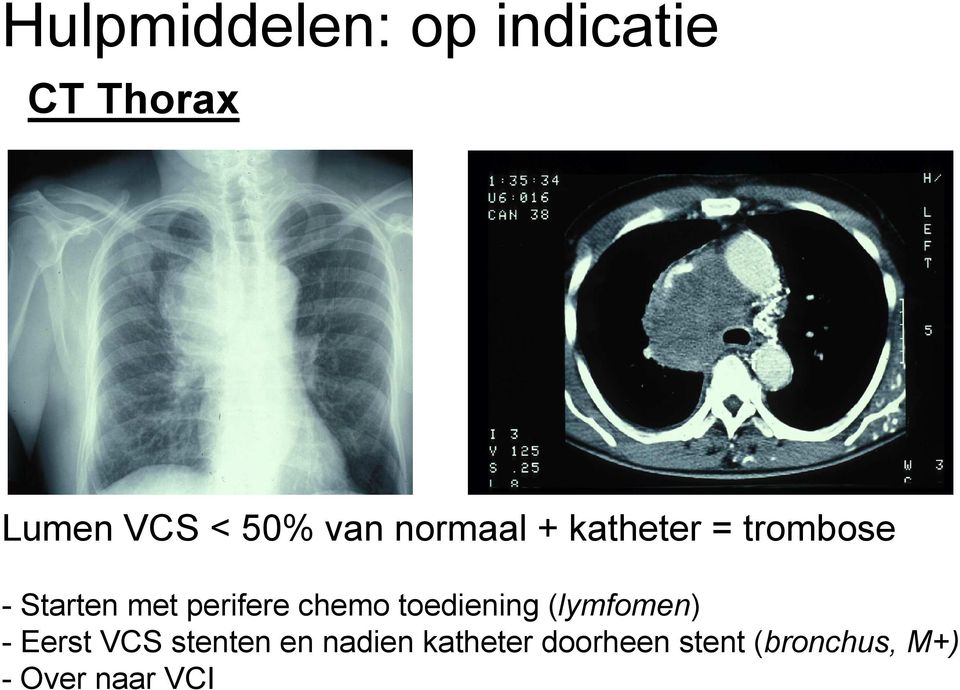 perifere chemo toediening (lymfomen) - Eerst VCS