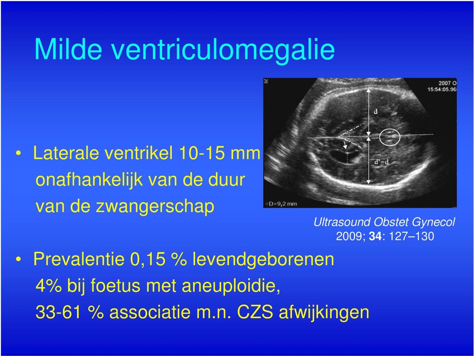 0,15 % levendgeborenen 4% bij foetus met aneuploidie, 33-61 %