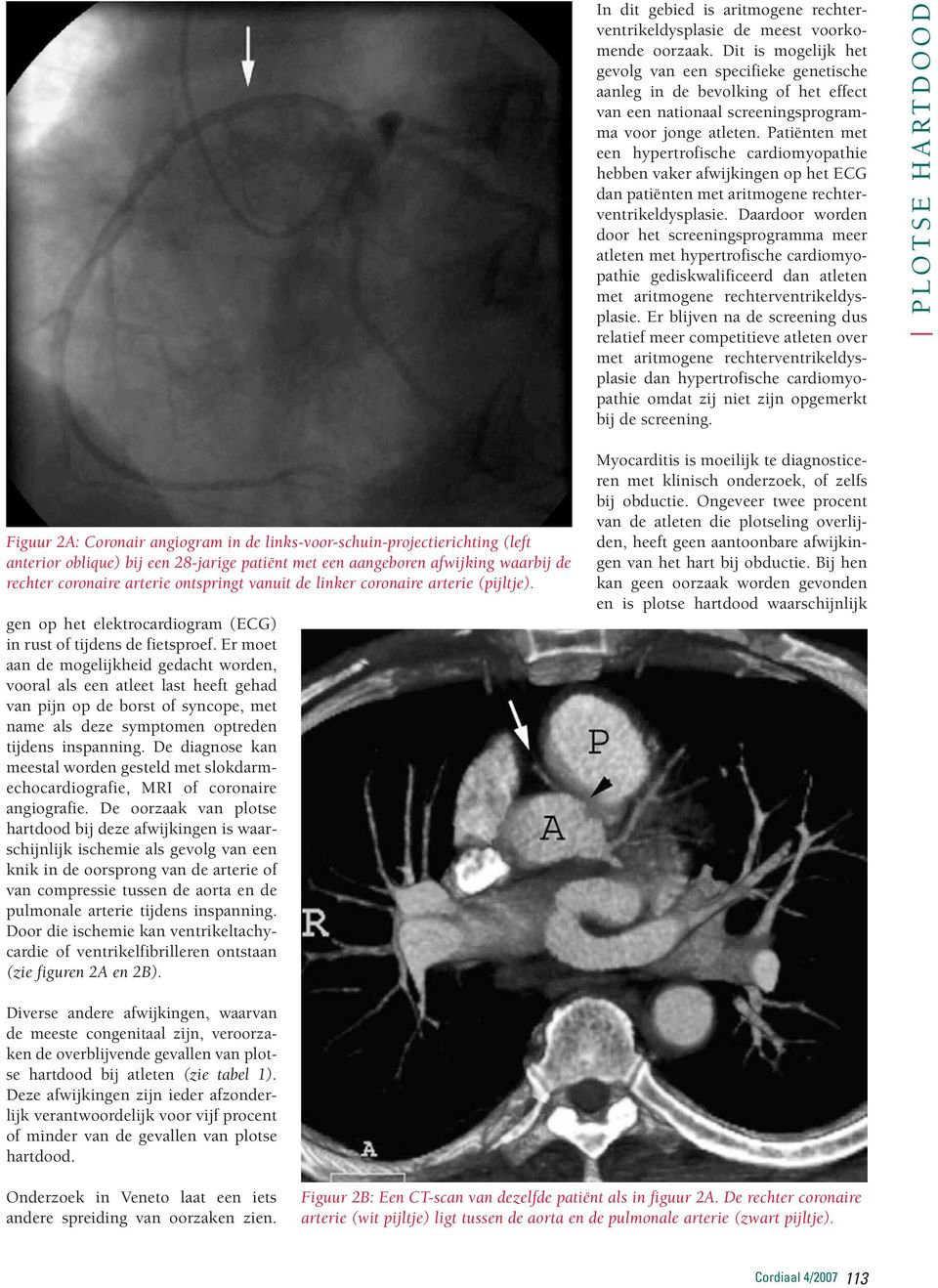 Patiënten met een hypertrofische cardiomyopathie hebben vaker afwijkingen op het ECG dan patiënten met aritmogene rechterventrikeldysplasie.