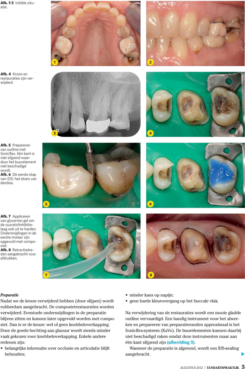 Ondersnijdingen in de eerste molaar zijn opgevuld met composiet. Afb. 8 Retractiedraden aangebracht voor afdrukken.