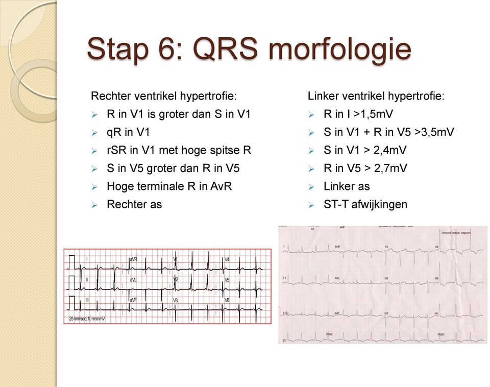 terminale R in AvR Rechter as Linker ventrikel hypertrofie: R in I >1,5mV S