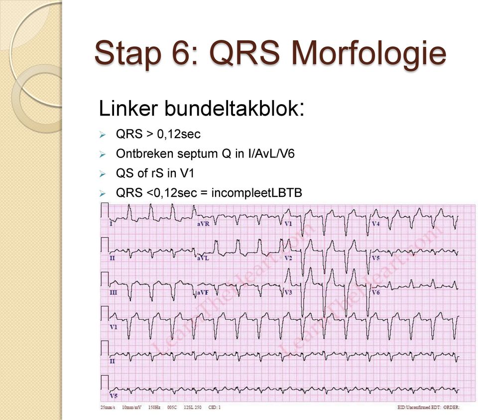 Ontbreken septum Q in I/AvL/V6 QS
