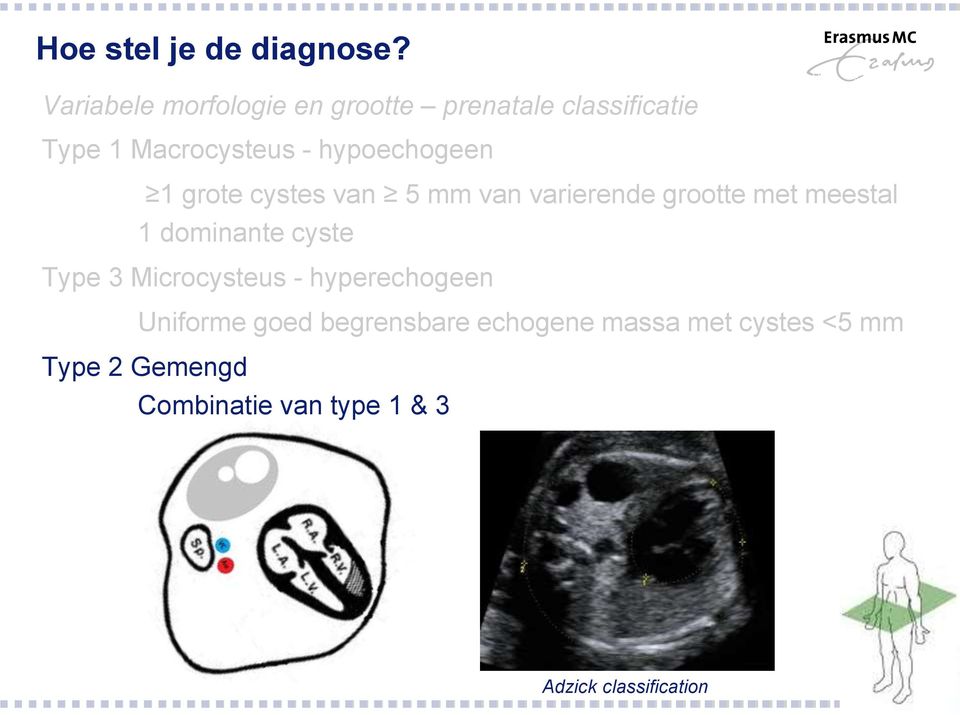 hypoechogeen 1 grote cystes van 5 mm van varierende grootte met meestal 1 dominante