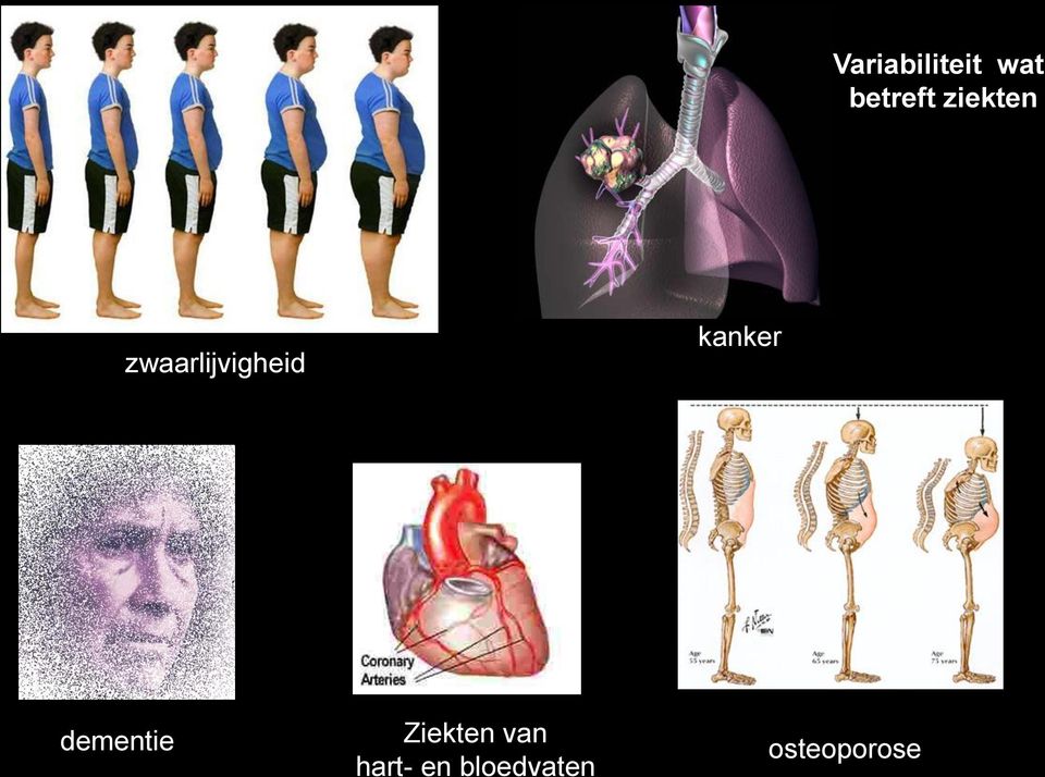 kanker dementie Ziekten van