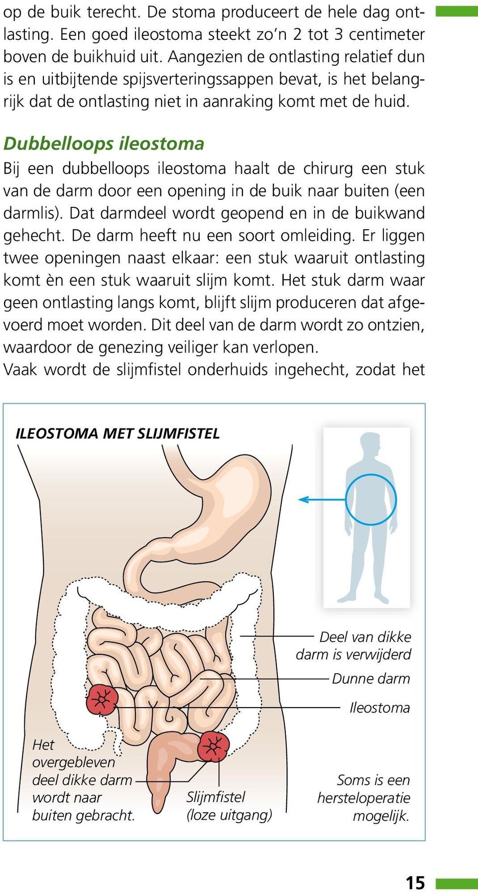 Dubbelloops ileostoma Bij een dubbelloops ileostoma haalt de chirurg een stuk van de darm door een opening in de buik naar buiten (een darmlis). Dat darmdeel wordt geopend en in de buikwand gehecht.