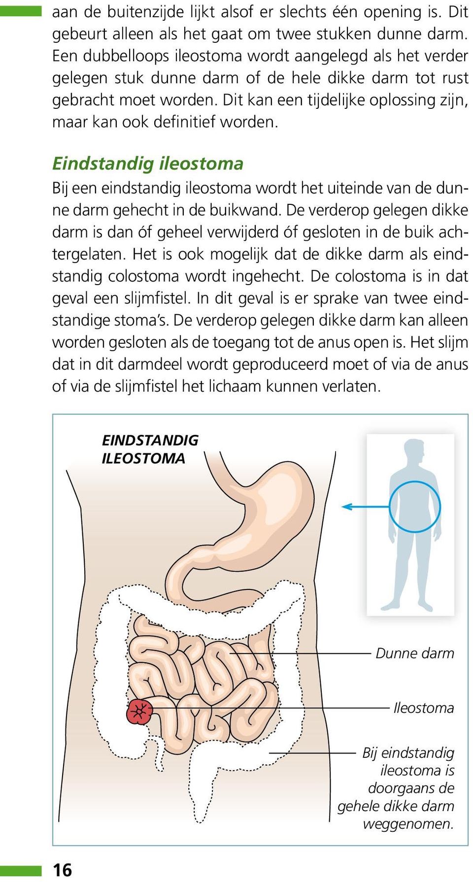 Dit kan een tijdelijke oplossing zijn, maar kan ook definitief worden. Eindstandig ileostoma Bij een eindstandig ileostoma wordt het uiteinde van de dunne darm gehecht in de buikwand.