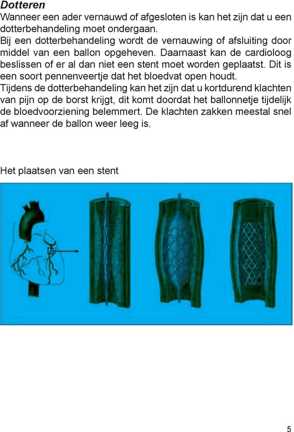 Daarnaast kan de cardioloog beslissen of er al dan niet een stent moet worden geplaatst. Dit is een soort pennenveertje dat het bloedvat open houdt.