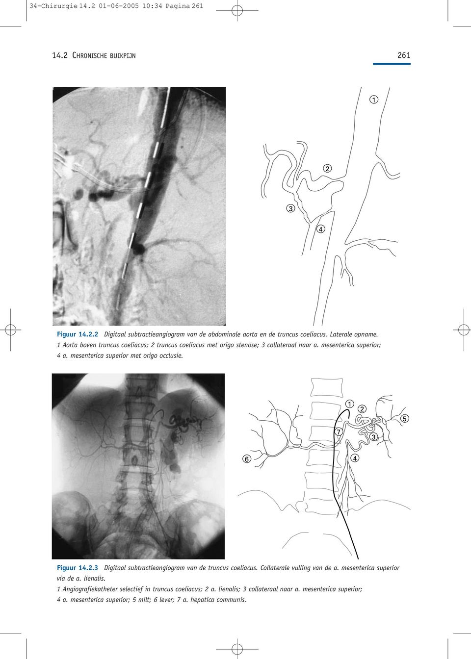 mesenterica superior met origo occlusie. 1 2 5 7 3 6 4 Figuur 14.2.3 Digitaal subtractieangiogram van de truncus coeliacus. Collaterale vulling van de a.