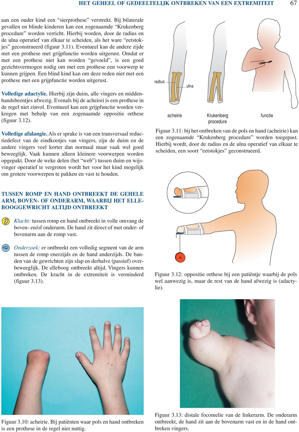 Hierbij worden, door de radius en de ulna operatief van elkaar te scheiden, als het ware eetstokjes geconstrueerd (figuur 3.11).