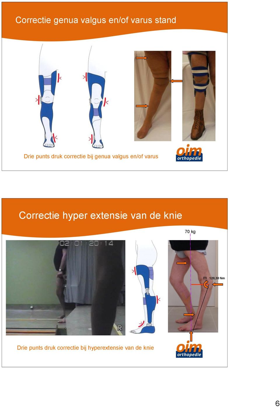 Correctie hyper extensie van de knie 70 kg m 120,30