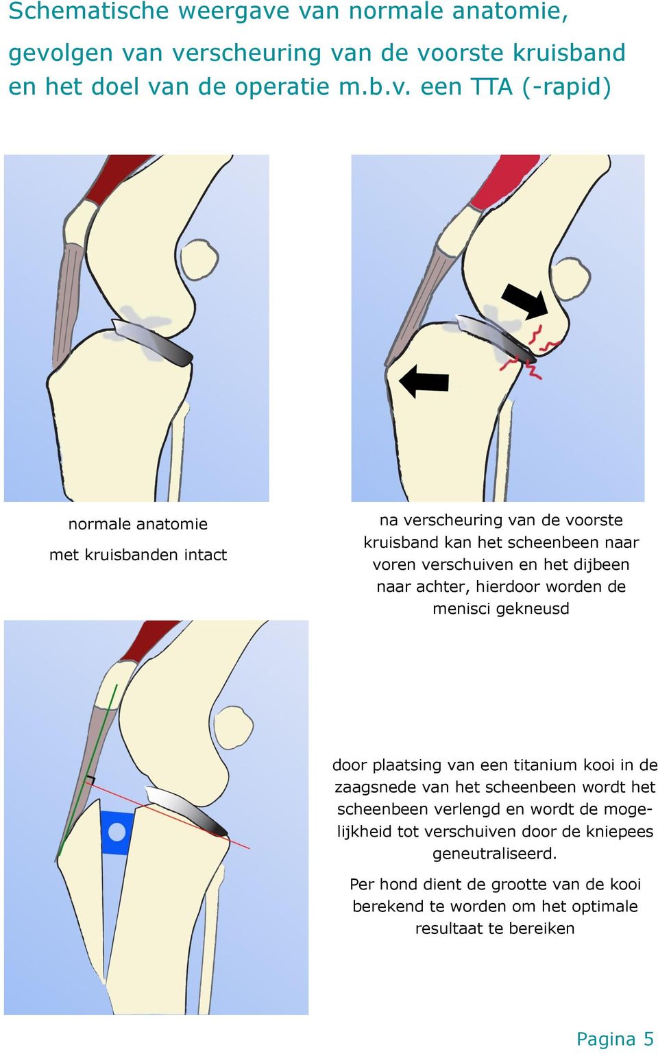 kruisbanden intact na verscheuring van de voorste kruisband kan het scheenbeen naar voren verschuiven en het dijbeen naar achter, hierdoor worden de