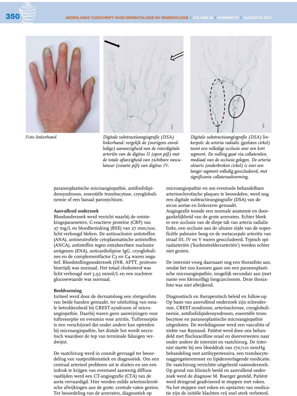 vasculatuur (zwarte pijl) van digitus IV. Digitale substractieangiografie (DSA) linkerpols: de arteria radialis (gesloten cirkel) toont een volledige occlusie over een kort segment.