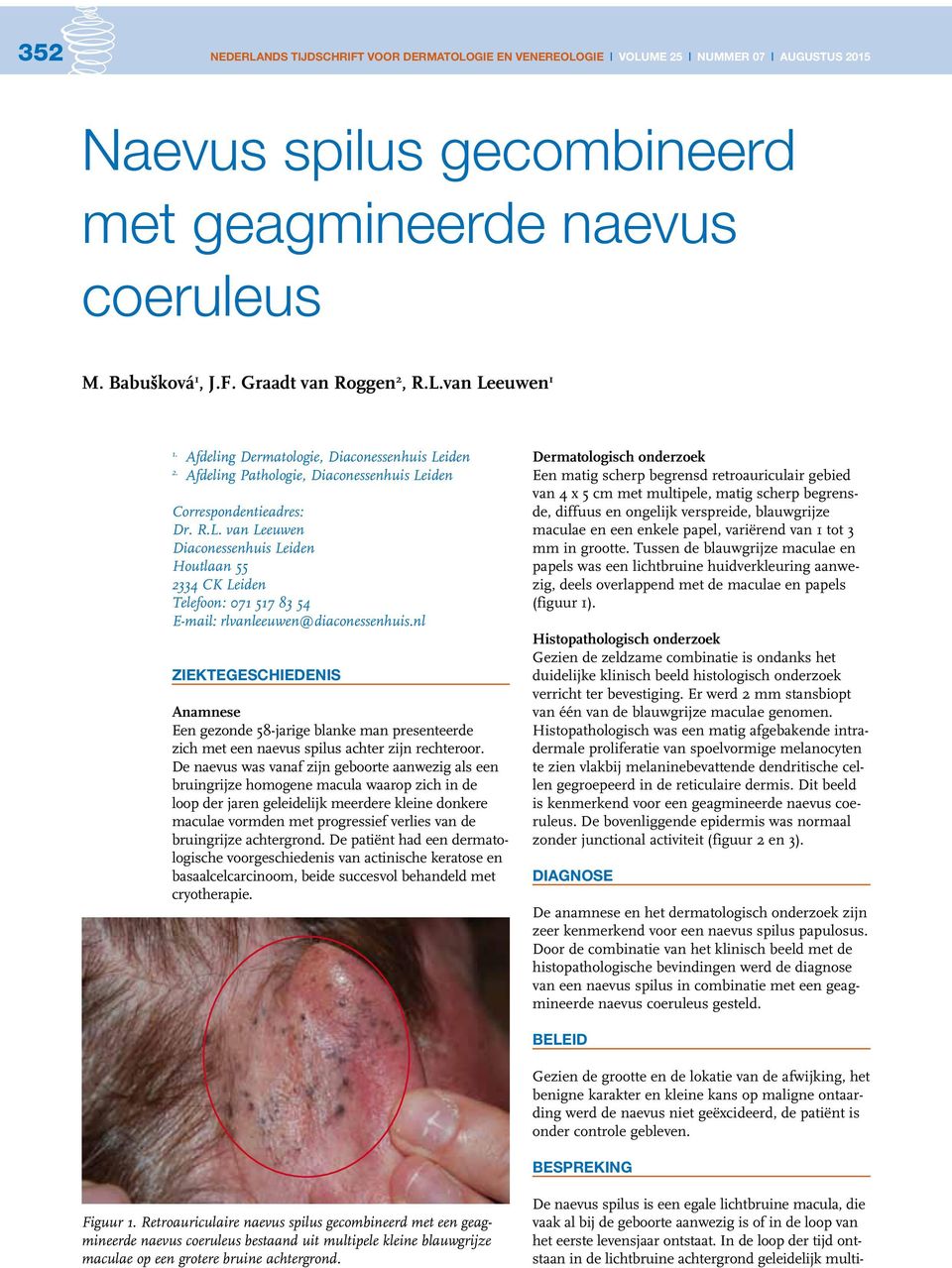 nl ZIEKTEGESCHIEDENIS Anamnese Een gezonde 58-jarige blanke man presenteerde zich met een naevus spilus achter zijn rechteroor.