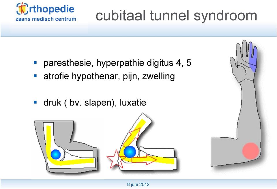 digitus 4, 5 atrofie