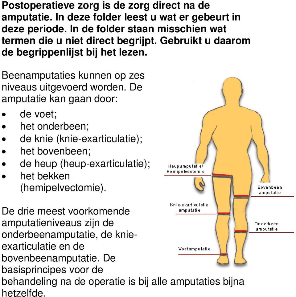 Beenamputaties kunnen op zes niveaus uitgevoerd worden.