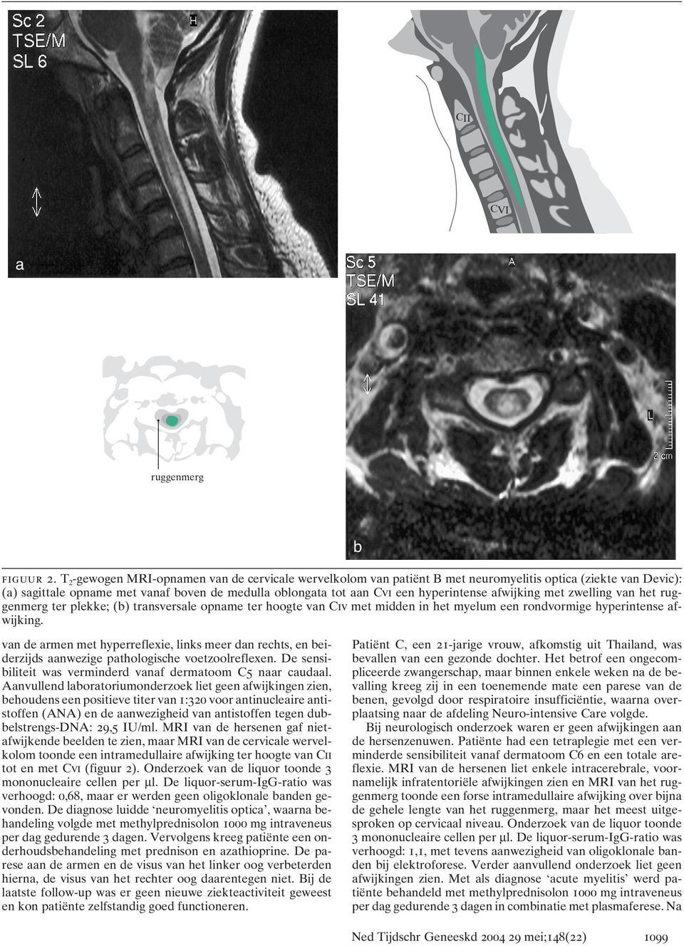 afwijking met zwelling van het ruggenmerg ter plekke; (b) transversale opname ter hoogte van Civ met midden in het myelum een rondvormige hyperintense afwijking.