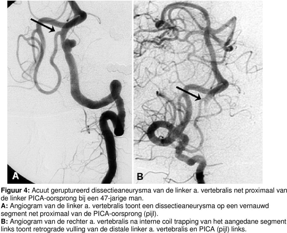 vertebralis toont een dissectieaneurysma op een vernauwd segment net proximaal van de PICA-oorsprong (pijl).