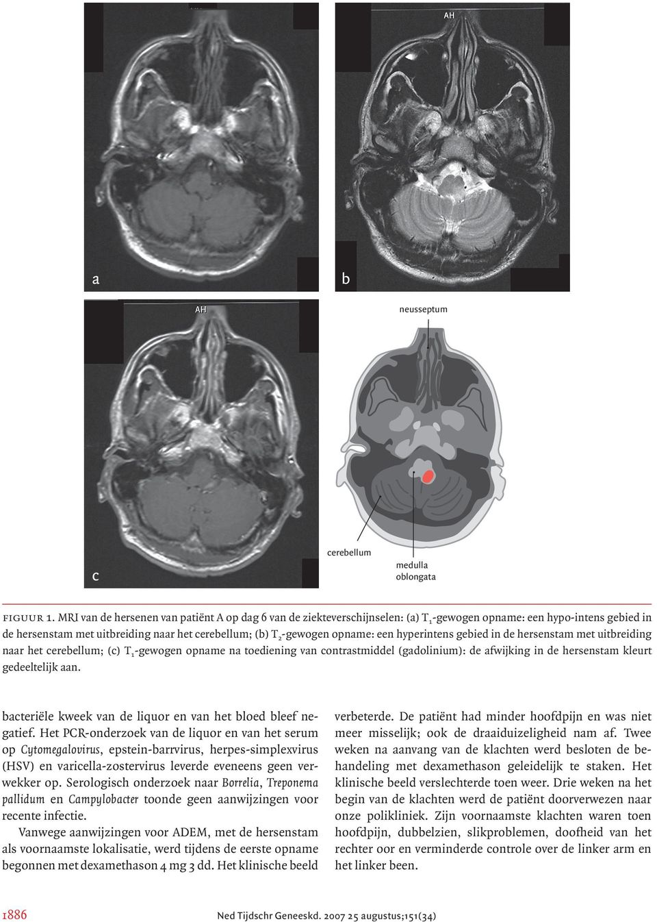 een hyperintens gebied in de hersenstam met uitbreiding naar het cerebellum; (c) T 1 -gewogen opname na toediening van contrastmiddel (gadolinium): de afwijking in de hersenstam kleurt gedeeltelijk