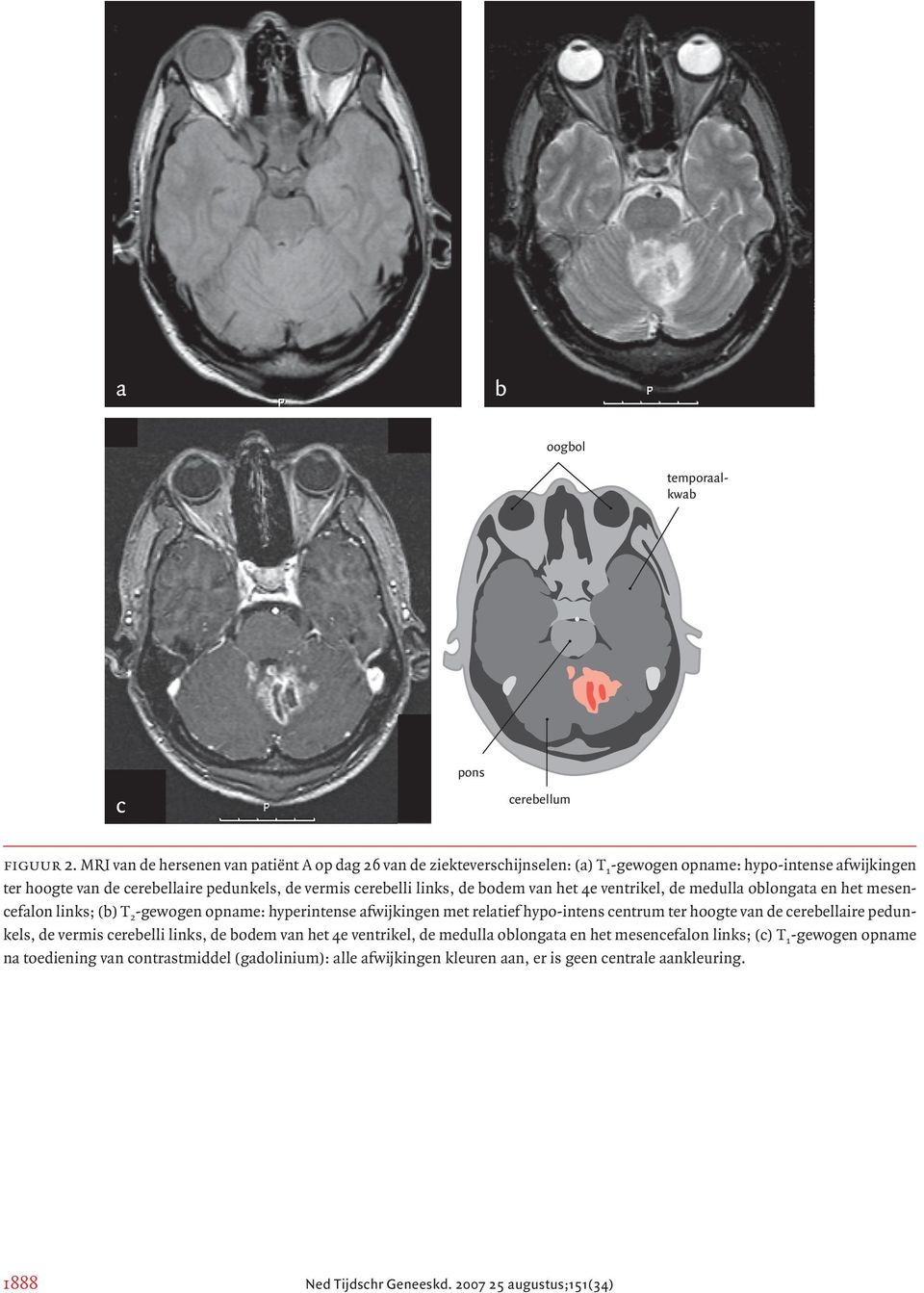 links, de bodem van het 4e ventrikel, de medulla oblongata en het mesencefalon links; (b) T 2 -gewogen opname: hyperintense afwijkingen met relatief hypo-intens centrum ter hoogte van