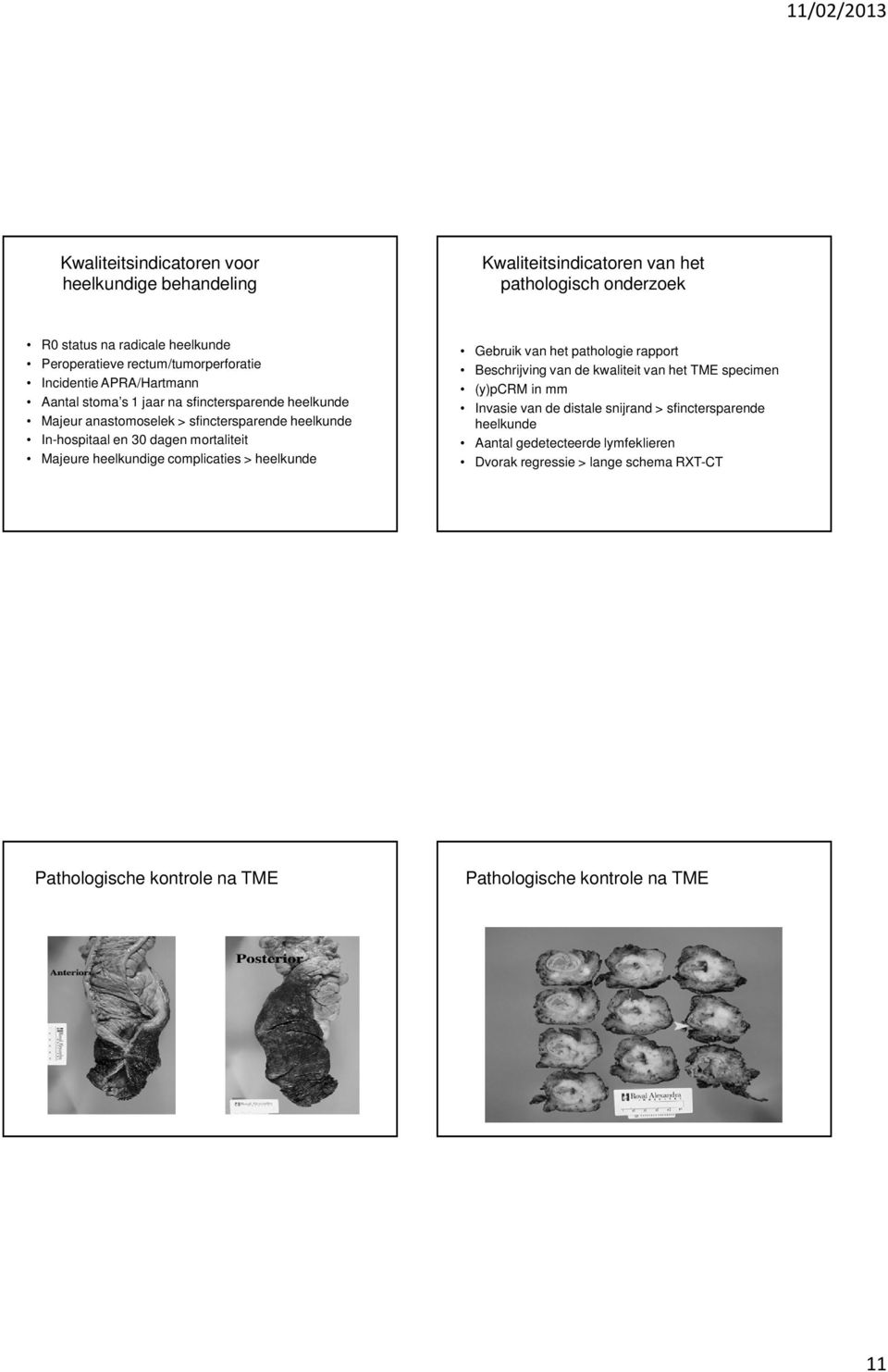 dagen mortaliteit Majeure heelkundige complicaties > heelkunde Gebruik van het pathologie rapport Beschrijving van de kwaliteit van het TME specimen (y)pcrm in mm