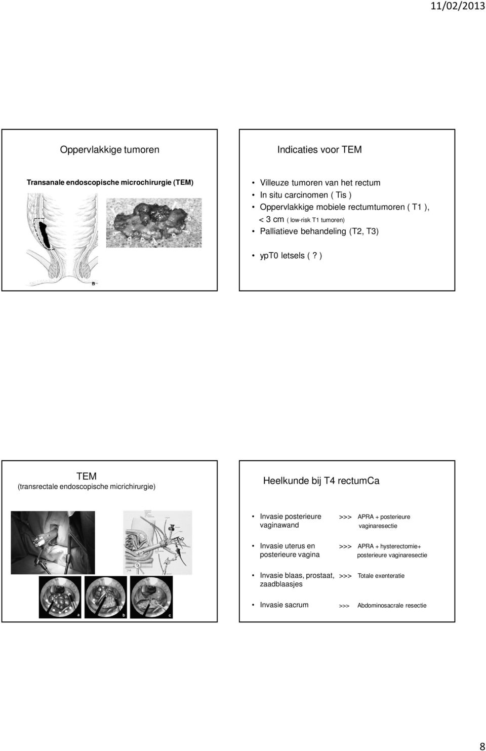 ) TEM (transrectale endoscopische micrichirurgie) Heelkunde bij T4 rectumca Invasie posterieure vaginawand >>> APRA + posterieure vaginaresectie Invasie