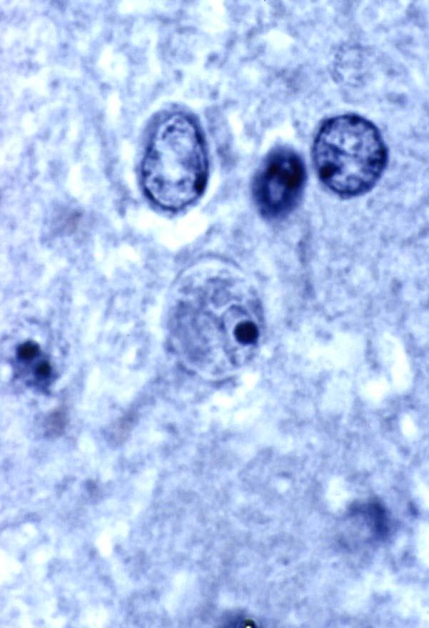 amoebenencephalitis (Naegleria