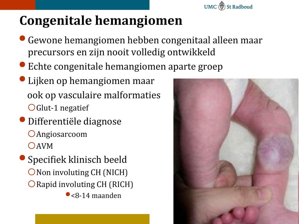 ook op vasculaire malformaties oglut-1 negatief Differentiële diagnose oangiosarcoom oavm