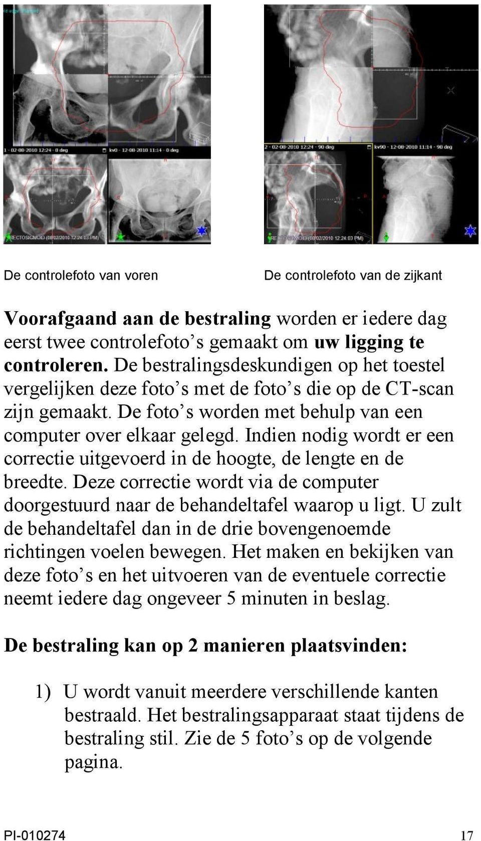 Indien nodig wordt er een correctie uitgevoerd in de hoogte, de lengte en de breedte. Deze correctie wordt via de computer doorgestuurd naar de behandeltafel waarop u ligt.