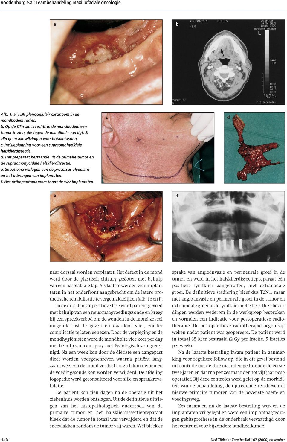 Het preparaat bestaande uit de primaire tumor en de supraomohyoïdale halsklierdissectie. e. Situatie na verlagen van de processus alveolaris en het inbrengen van implantaten. f.