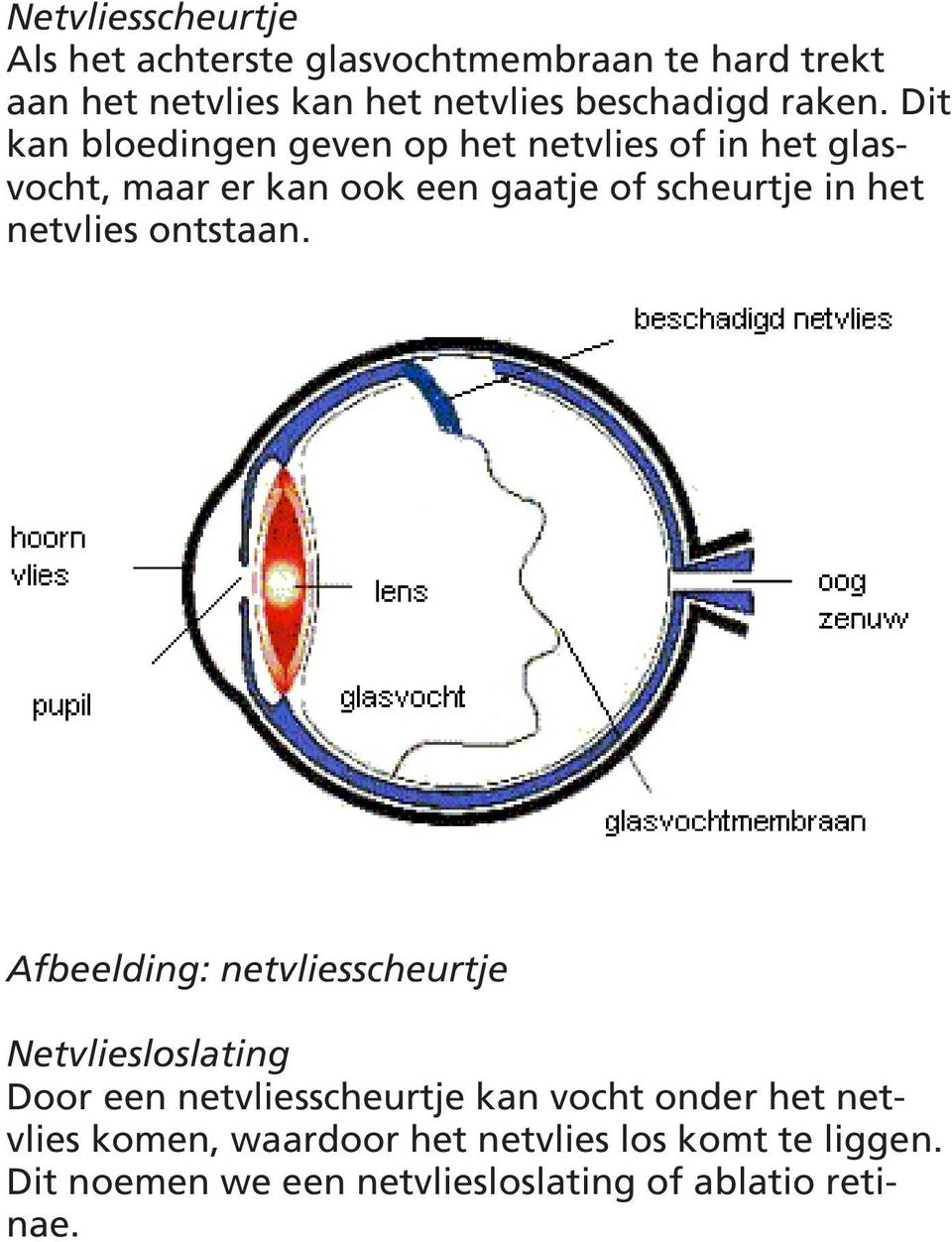 Dit kan bloedingen geven op het netvlies of in het glasvocht, maar er kan ook een gaatje of scheurtje in het